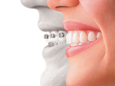 Lee Dental   Facial | Bone Grafts, Dental Sealants and daVinci    Veneers